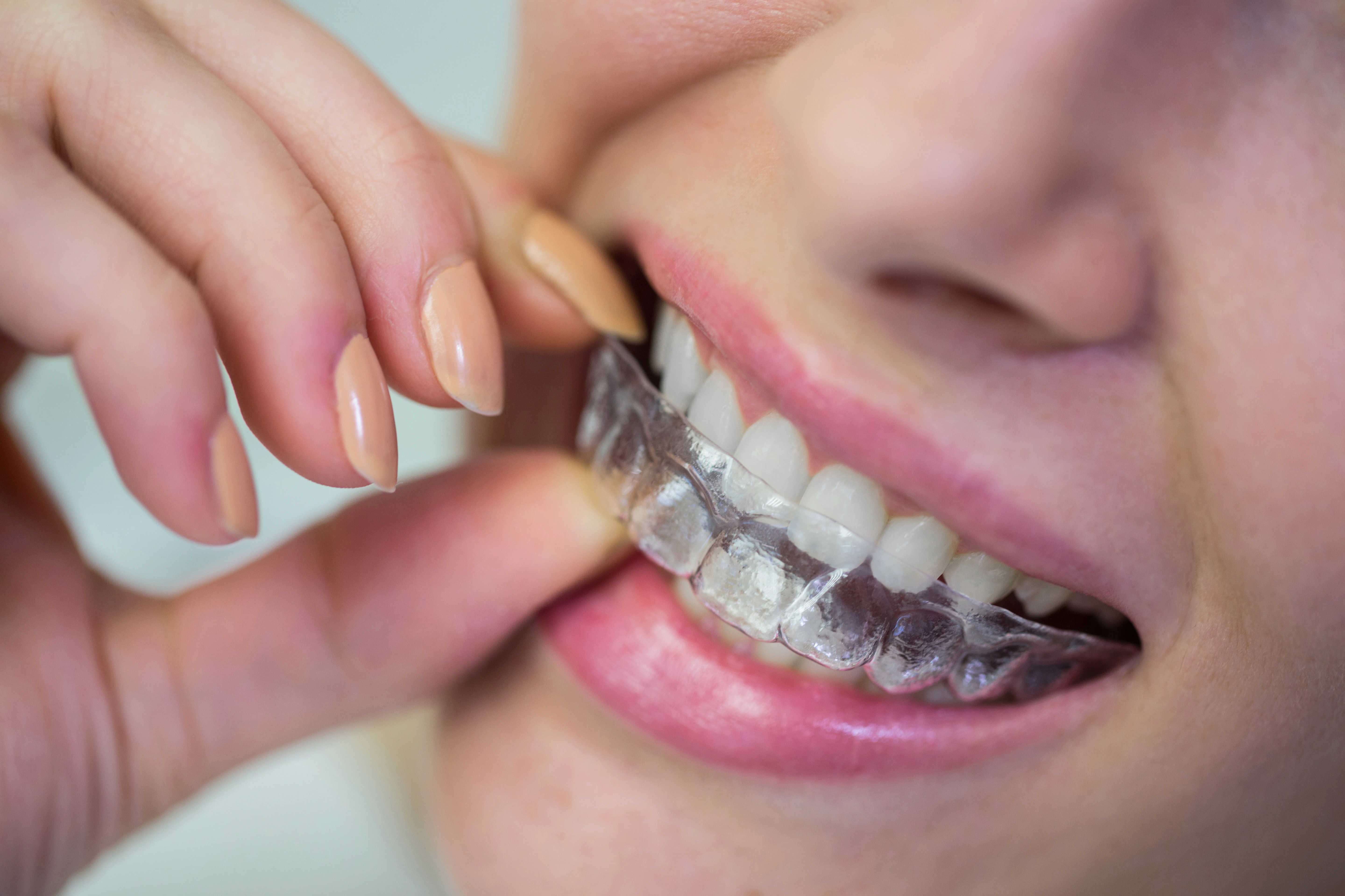 Smile Designing